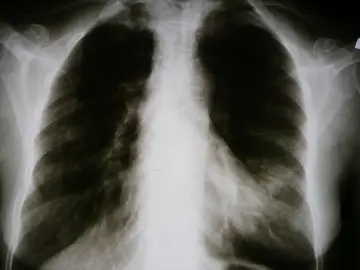 Fotografía de archivo que ilustra: Microsoft Research presenta CARE-X, modelo de IA de investigación para radiología de tórax